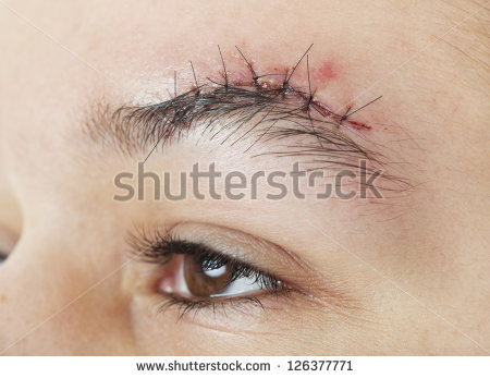 Gash Above The Eyebrow That Has Just Received 7 Stitches To Close It