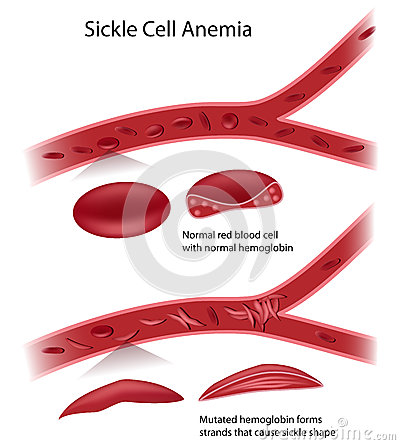 Cell Shape And Blockage Of Blood Flow In Sickle Cell Anemia Eps10