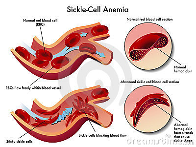 Sickle Cell Anemia Royalty Free Stock Images   Image  23933699