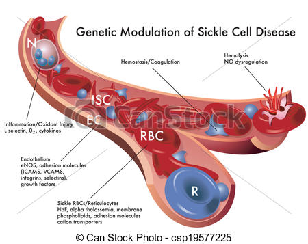 Sickle Cell Disease   Csp19577225