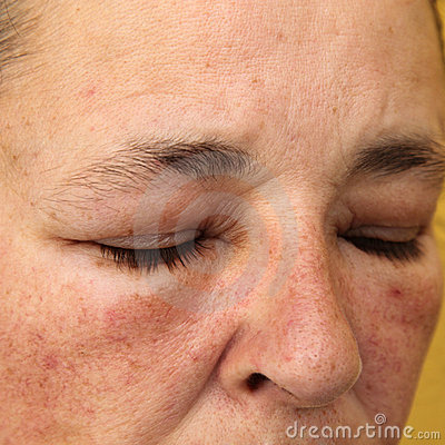 More Similar Stock Images Of   Swollen Eyes And Face For Allergy