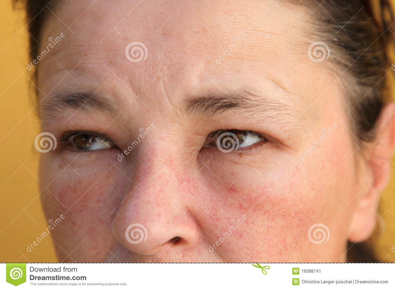 Stock Image  Allergies   Swollen Eyes And Face