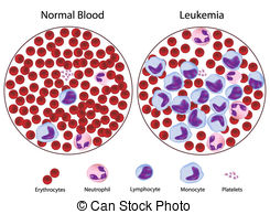 Leukemic Versus Normal Blood Vectors Illustration